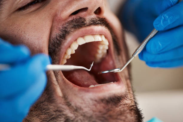 Best Emergency Wisdom Teeth Removal in Miamitown, OH
